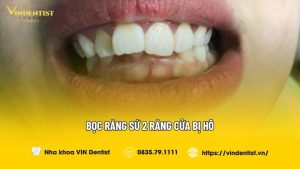 Bọc răng sứ 2 răng cửa bị hô