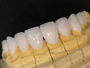 Chọn loại răng sứ chất lượng