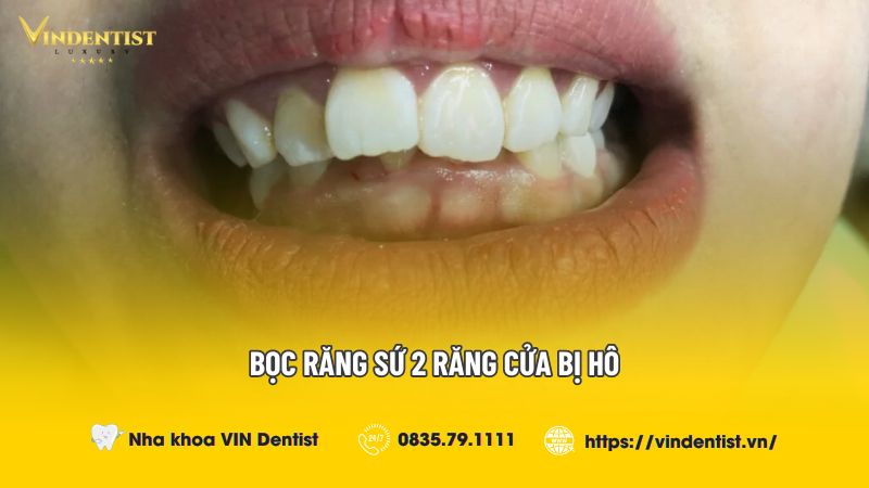 Bọc răng sứ 2 răng cửa bị hô