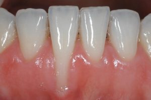 Tụt nướu, viêm nướu chân răng