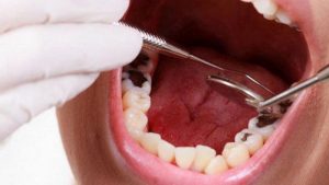 Trường hợp răng sâu lỗ lớn