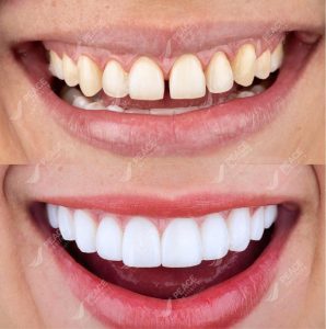 Những trường hợp nên bọc sứ răng cửa