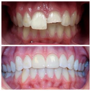 Ưu điểm khi bọc sứ răng cửa