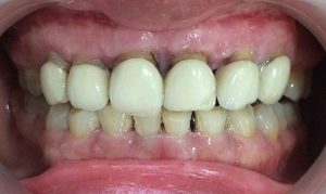 Hôi miệng do mão sứ kém chất lượng