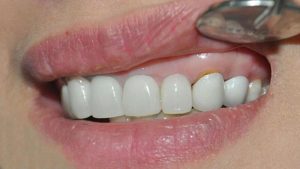 Răng bị dị ứng với kim loại