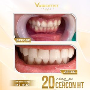 Bọc răng 20 răng sứ Cercon HT cho khách hàng Mỹ Hoa với tổng chi phí 100 triệu