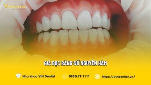 Giá bọc răng sứ nguyên hàm