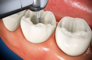 Lợi ích khi lấy tủy bọc răng sứ