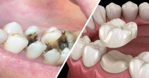 lấy tủy bọc răng sứ giá bao nhiêu