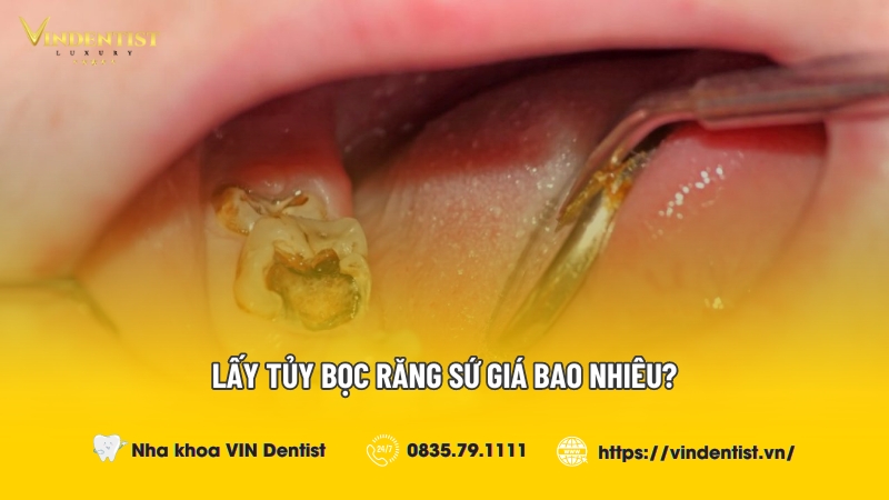 Lấy tủy bọc răng sứ giá bao nhiêu? - Nha Khoa VIN Dentist Đà Nẵng