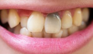 Chưa điều trị triệt để bệnh viêm tủy