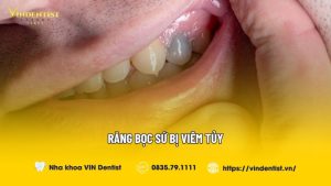 Răng bọc sứ bị viêm tủy