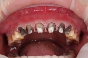 Nguy cơ bị hỏng chân răng thật