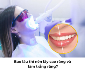 Bao lâu thì nên lấy cao răng và làm trắng răng?