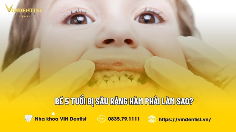 bé 5 tuổi bị sâu răng hàm phải làm sao