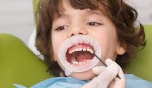 Điều trị bằng cách trám răng
