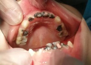 Bé 5 tuổi bị sâu răng hàm ở mức độ nặng