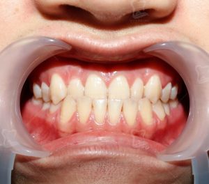 Tình trạng bọc răng sứ bị lệch khớp cắn