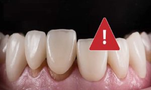 Sai kích thước của mão răng sứ