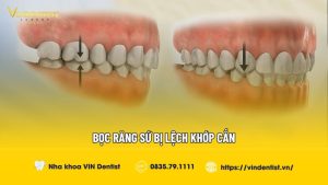 Bọc răng sứ bị lệch khớp cắn