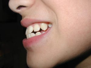 Bọc răng sứ có hết hô không?