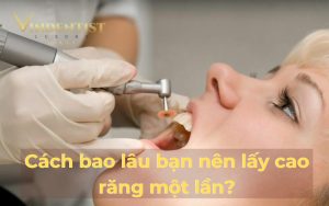 Cách bao lâu bạn nên lấy cao răng một lần?