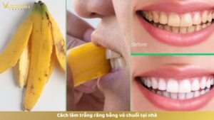 Cách làm trắng răng bằng vỏ chuối tại nhà