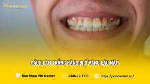 Cách làm trắng răng bị ố vàng lâu năm