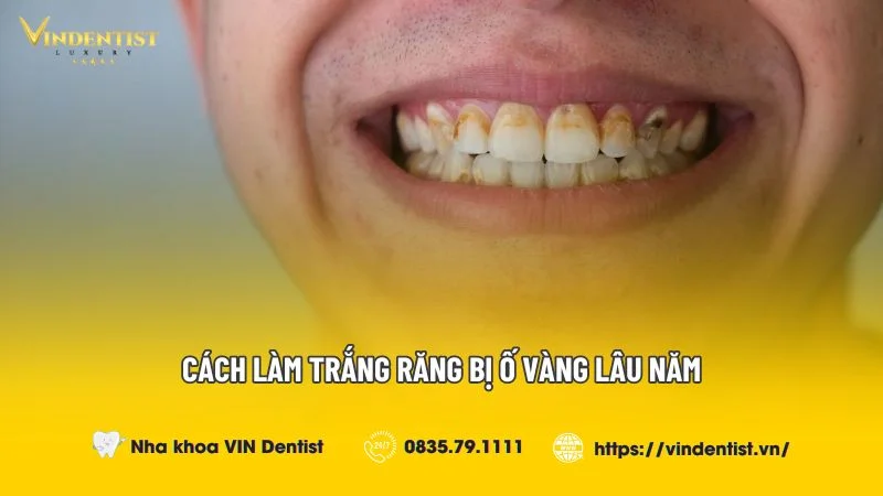 4. Lưu ý khi làm trắng răng bị ố vàng