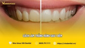 Cách làm trắng răng sau 1 đêm