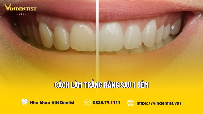 Cách làm trắng răng sau 1 đêm