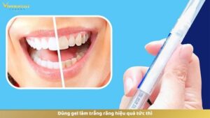 Dùng gel làm trắng răng hiệu quả tức thì
