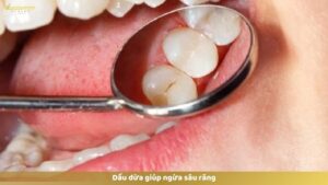 Ngừa sâu răng