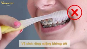 Những nguyên nhân dẫn đến răng bị ố vàng