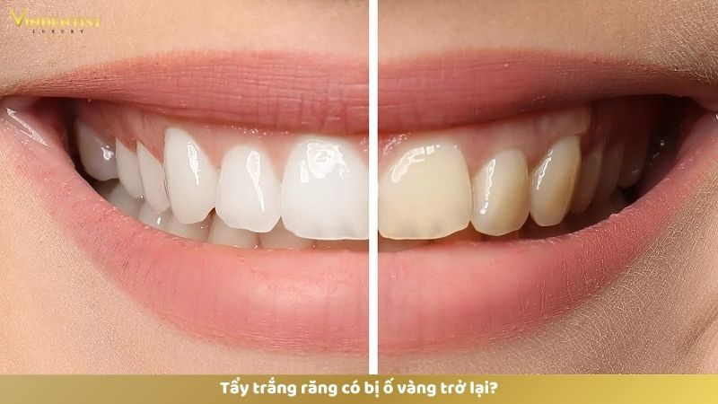 Làm Gì Sau Khi Tẩy Trắng Răng? 14 Tẩy trắng răng có bị ố vàng trở lại?
