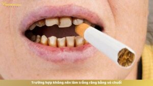 Trường hợp không nên làm trắng răng bằng vỏ chuối?