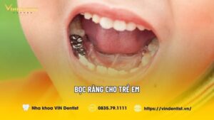 Bọc Răng Cho Trẻ Em An Toàn Hay Không? Giải Đáp Từ Bác Sĩ