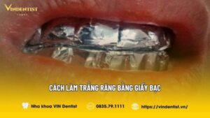 Bật Mí Cách Làm Trắng Răng Bằng Giấy Bạc Chỉ Trong 15 Phút