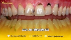 Cách Làm Trắng Răng Sâu Đơn Giản Mà Hiệu Quả Nhất