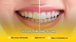Cách Làm Trắng Răng Sau Sinh Với Nguyên Liệu Tự Nhiên