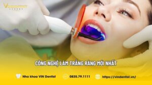 Tổng Hợp 10 Công Nghệ Làm Trắng Răng Mới Nhất Hiện Nay