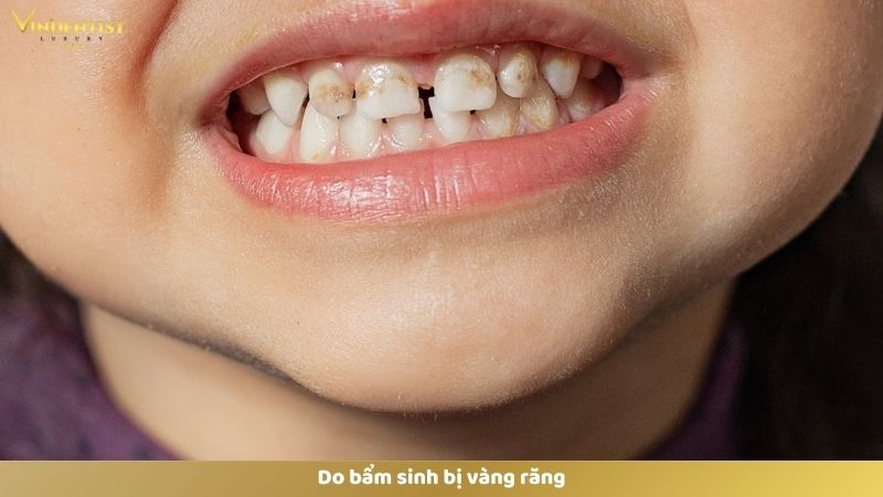 Bật Mí Cách Làm Trắng Răng Cho Bé 1 Tuổi An Toàn, Hiệu Quả 13 Do bẩm sinh