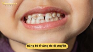 Răng bé ố vàng do di truyền