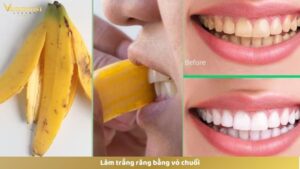 Dùng vỏ chuối làm trắng răng