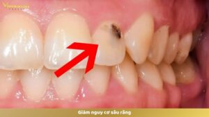 Giảm nguy cơ sâu răng