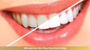 Hiệu quả cao, làm trắng răng nhanh chóng