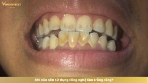 Khi nào nên sử dụng công nghệ làm trắng răng?