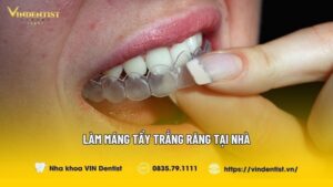 Cách Làm Máng tẩy Trắng Răng Tại Nhà Mang Lại Hiệu Quả