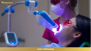 Laser Whitening
