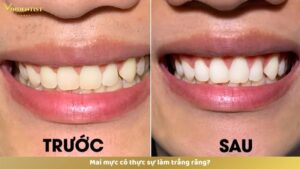 Mai mực có thực sự làm trắng răng?